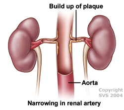 narrowing in renal artery