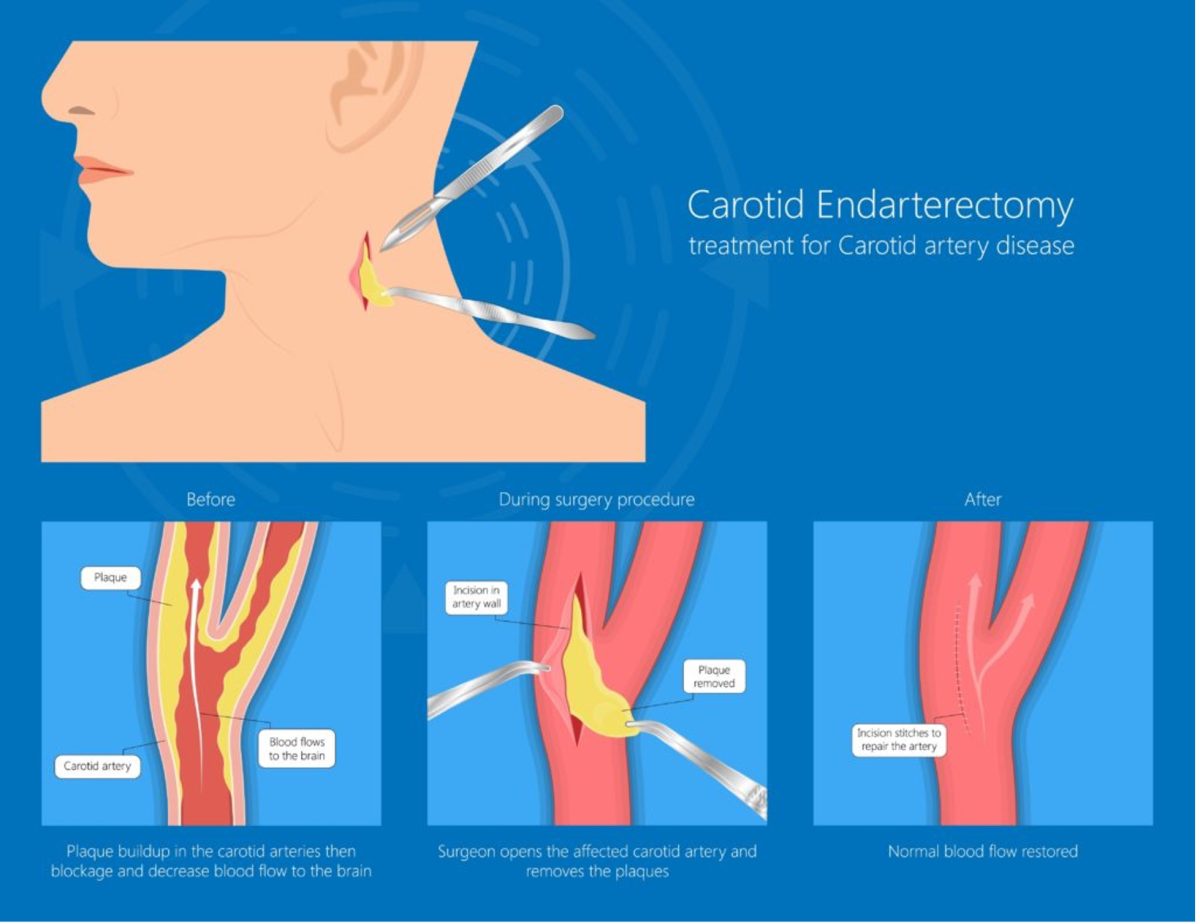 Treatments – Vascular Institute of Michigan